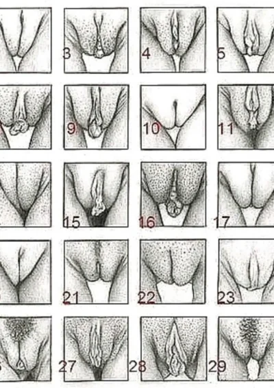 Шкала ферримана голлвея гирсутизм