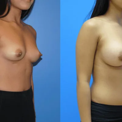 Вытянутая женская грудь