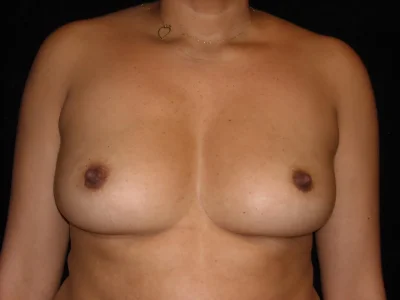 Breast reduction dr. richard