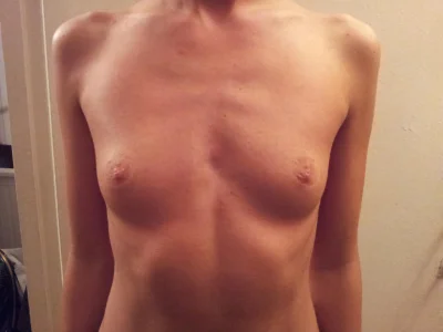 Грудь пластика