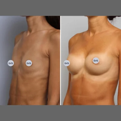 Грудь после увеличения