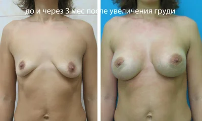 Порнозвезды до увеличения груди