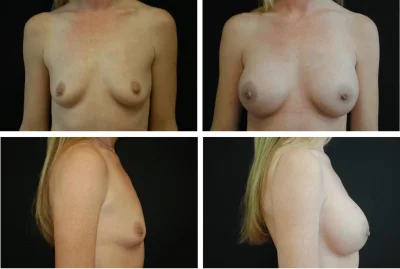 Увеличение груди филлерами