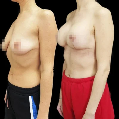 Мастопексия без имплантов