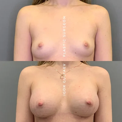 Сиськи импланты