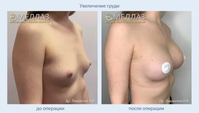 Пластическая хирургия груди