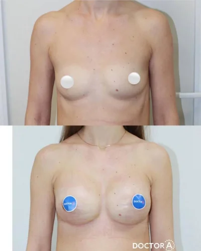 Круглые и анатомические импланты