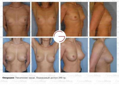 Увеличение груди с помощью жира