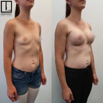 Грудь до и после операции