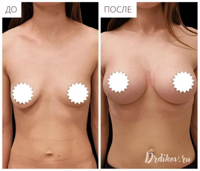 Подтяжка груди