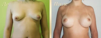 Асимметрия груди у женщин