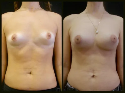 Липосакция липоскульптурирование