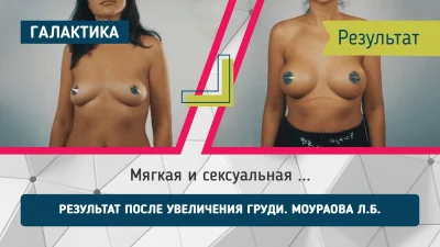 Пластическая грудь