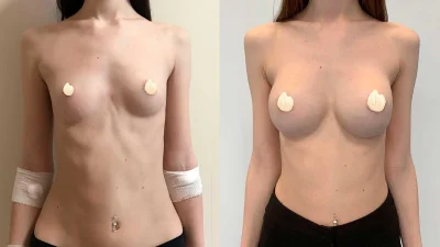 Несформированная грудь