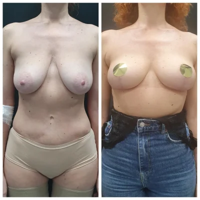 Подтяжка груди без имплантов