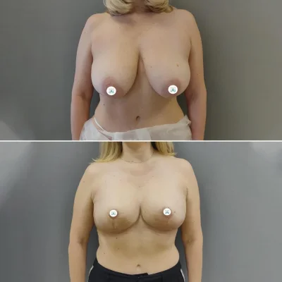 Подтяжка груди