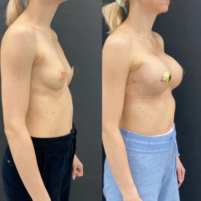 Увеличение молочных желез