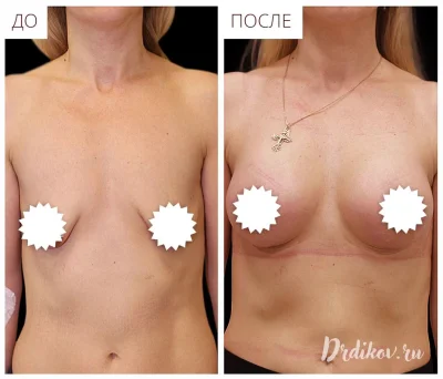 До и после подтяжки груди