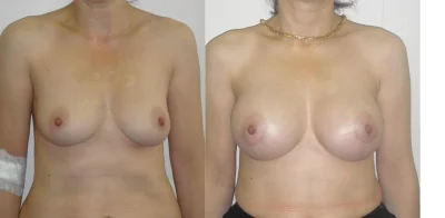 Breast reduction dr. richard