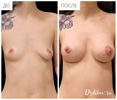 Операция по увеличению груди