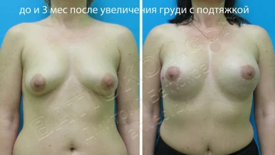 Грудь тубулярная