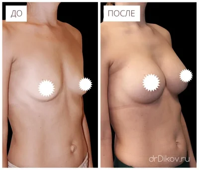 Грудь после маммопластики