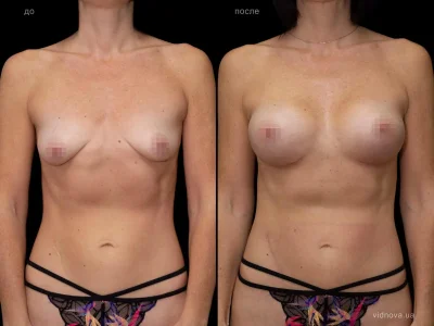 Подтяжка груди