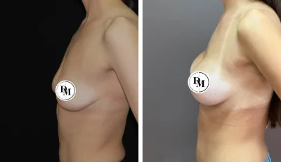 Анатомический имплант груди