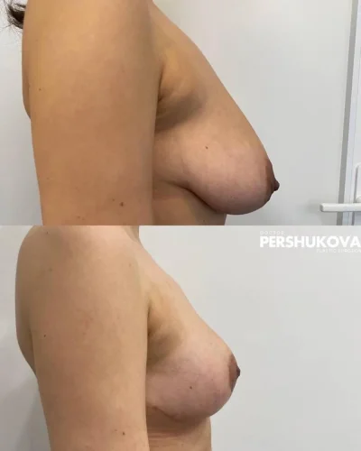 Уменьшение груди