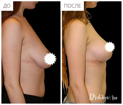 Подтяжка груди операция