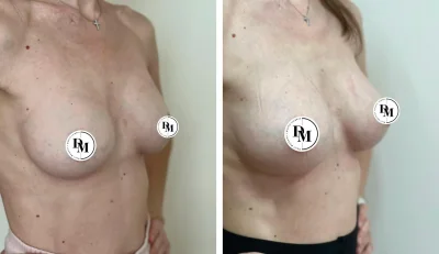 Аугментационная маммопластика