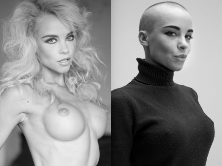 Bald girl