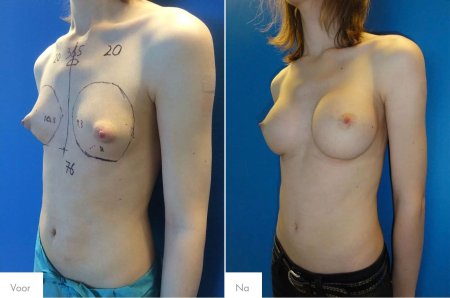Female breasts in transgender people