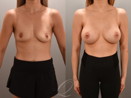 Before and after breast augmentation