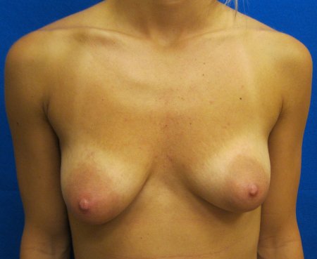 Naked small saggy tits