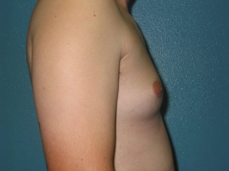 Gynecomastia klinefeltera