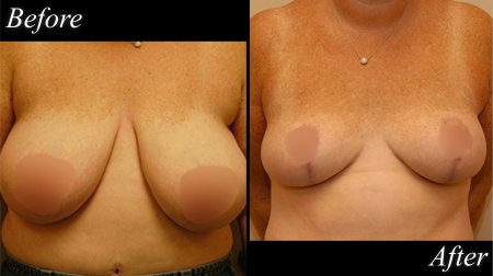 Scarjo Breast Reduction